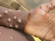 Dangerous Mpox strain Clade 1b may be spreading undetected in UK: Report