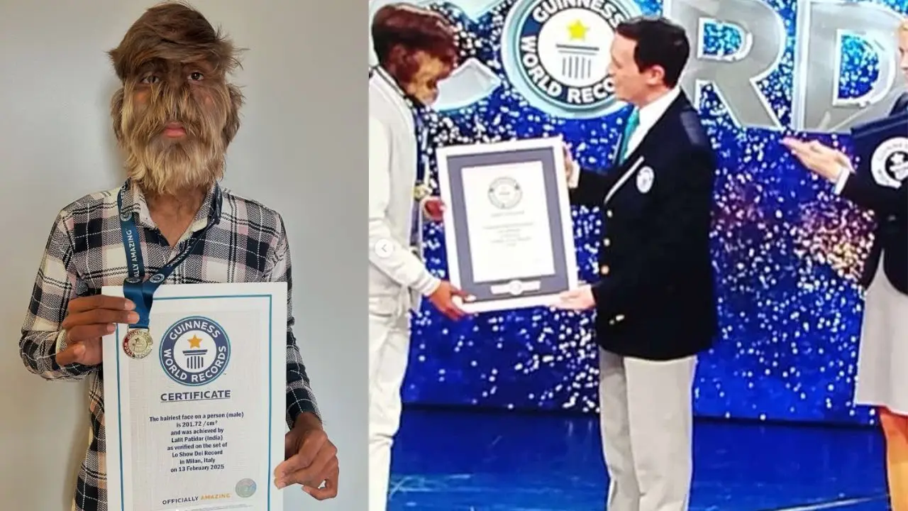 ‘Werewolf Syndrome’: Indian boy secures Guinness World Record for ‘hairiest face’ ‘Werewolf Syndrome’: Indian boy secures Guinness World Record for ‘hairiest face’