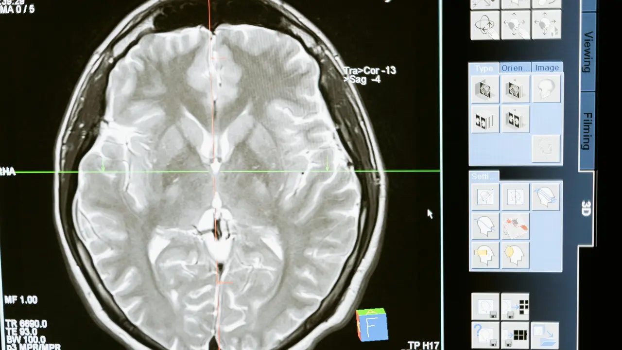 Woman experiencing hot pain in feet diagnosed with worms in brain. 'Fever, confusion...'
