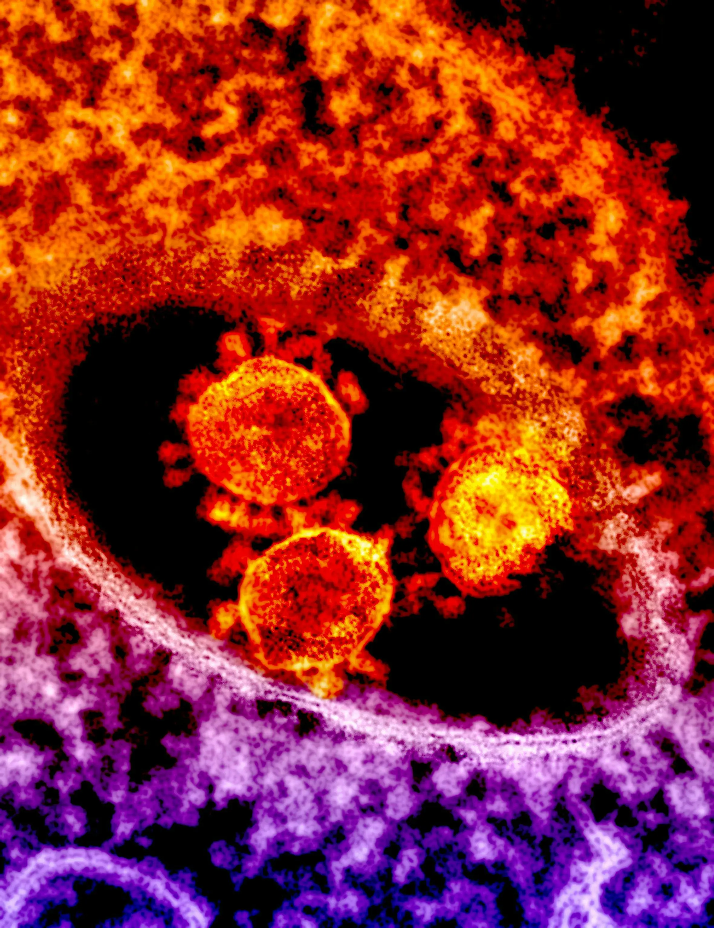 COVID-19 virus reaches 8-year-old girl's brain, putting her in coma before killing her