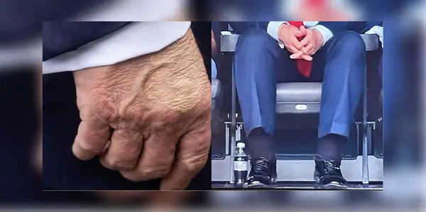 Trump’s ankles swollen due to chronic venous condition, hand bruises due to irritation from ‘handshakes’: White House Trump’s ankles swollen due to chronic venous condition, hand bruises due to irritation from ‘handshakes’: White House