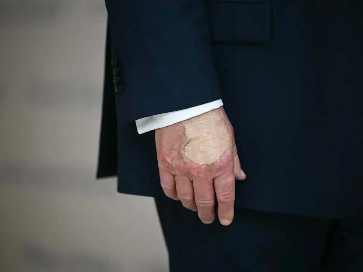 What's Trump hiding? Bizarre hand makeup sparks new health fears after 'Cankles' scandal What's Trump hiding? Bizarre hand makeup sparks new health fears after 'Cankles' scandal