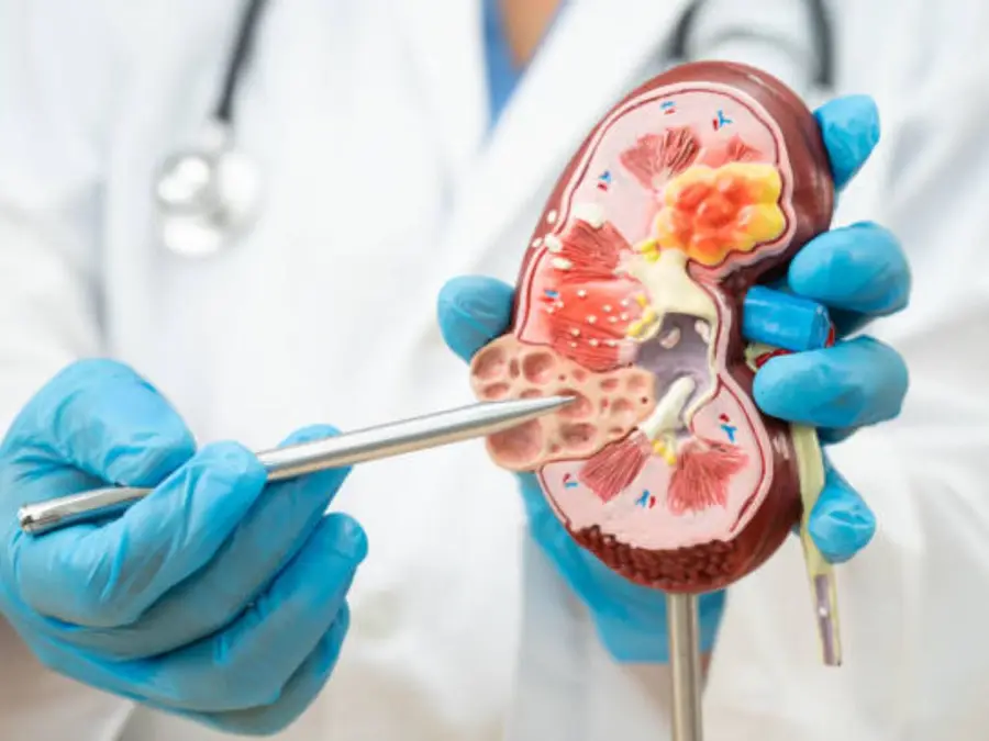 Wait, what? Night shifts linked to higher kidney stone risk, says study