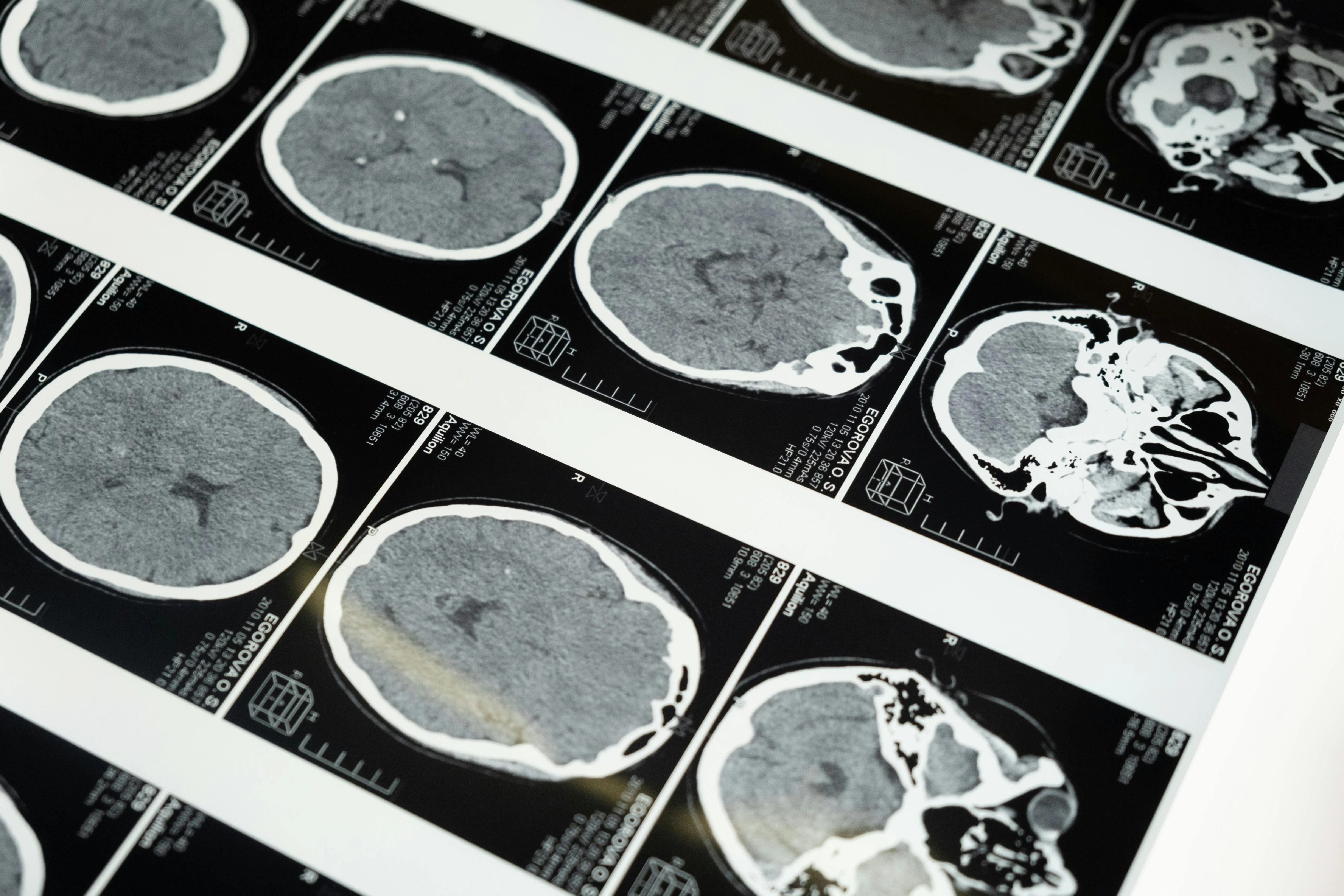 Kiwi woman’s 'golf-ball' brain tumour vanishes — Stunned doctors term her diagnosis 'medical anomaly'