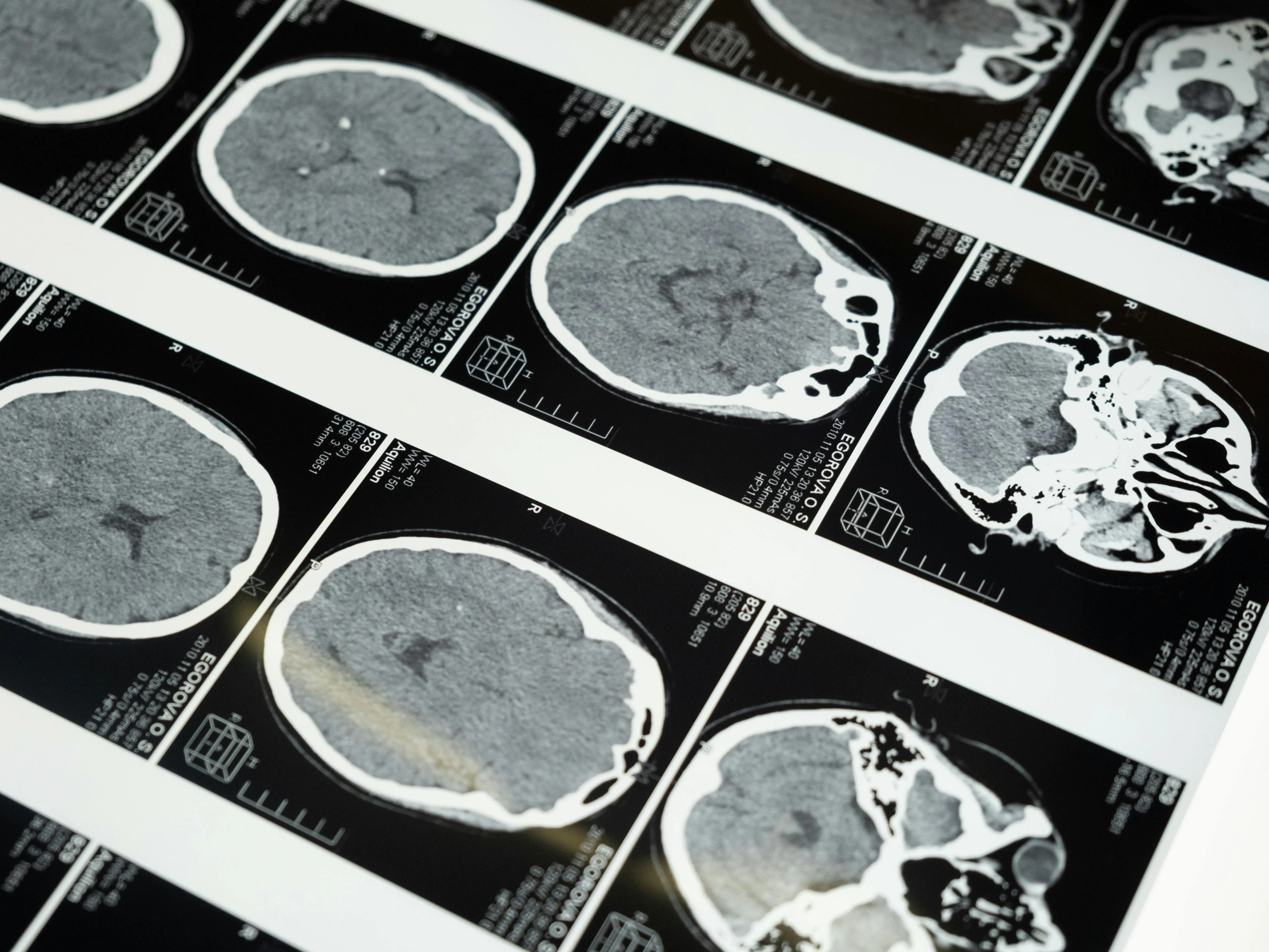 Kiwi woman’s 'golf-ball' brain tumour vanishes — Stunned doctors term her diagnosis 'medical anomaly' Kiwi woman’s 'golf-ball' brain tumour vanishes — Stunned doctors term her diagnosis 'medical anomaly'