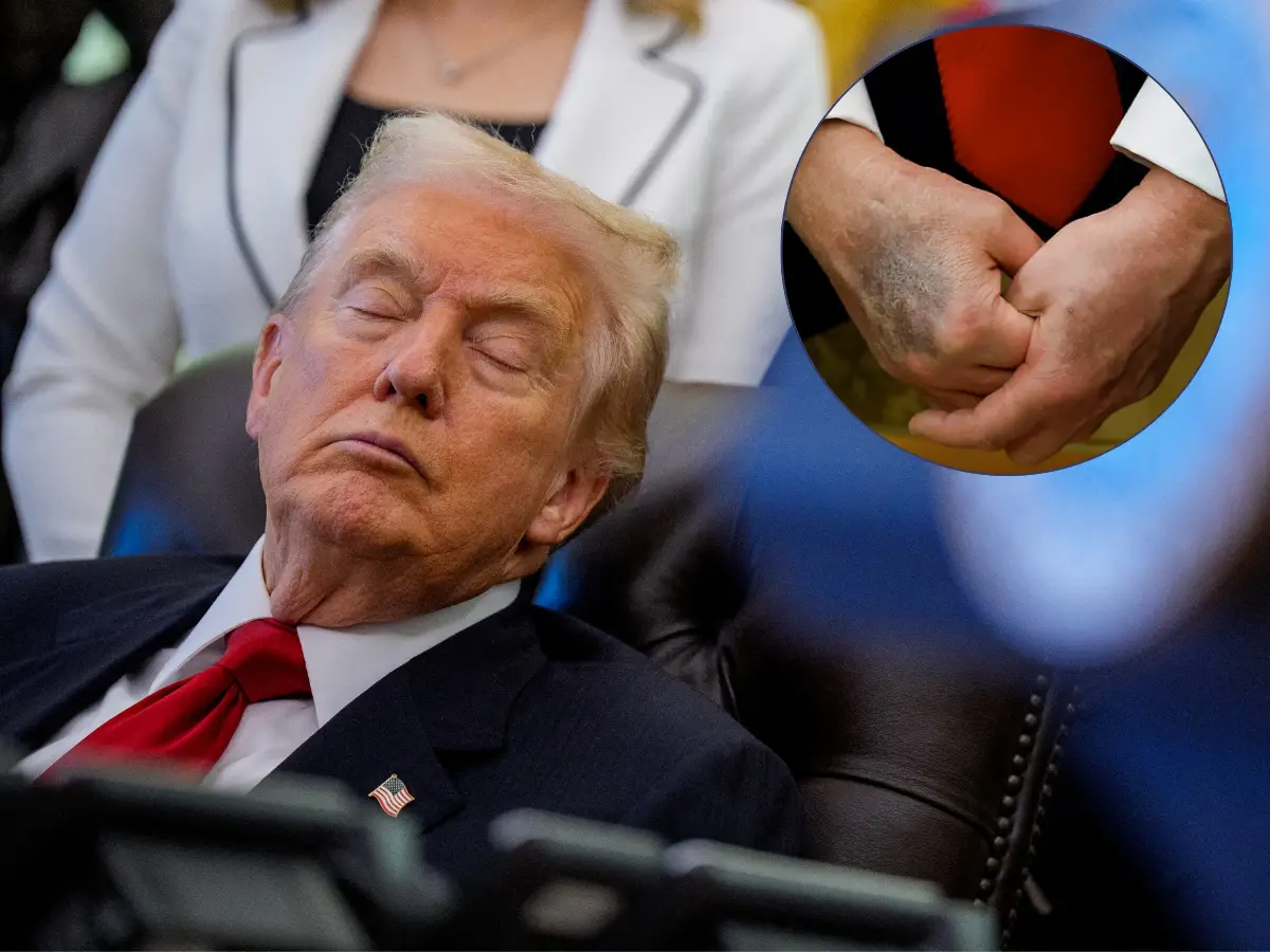 Make Aspirin 'Superstitious' Again? Trump contradicts White House, reveals shocking truth about bruises and MRI scans. Here's what he said Make Aspirin 'Superstitious' Again? Trump contradicts White House, reveals shocking truth about bruises and MRI scans. Here's what he said