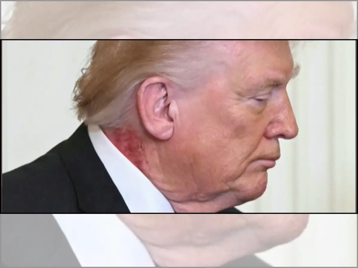 Trump was seen with a rash on his neck in March this year