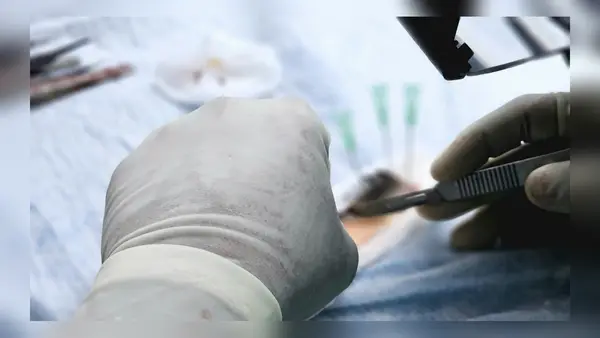 Pakistani Lashkar terrorist infiltrates to set up sleeper cells, gets hair transplant done in Srinagar Pakistani Lashkar terrorist infiltrates to set up sleeper cells, gets hair transplant done in Srinagar