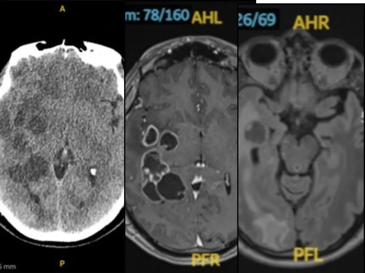 Worms in Spanish man's brain puzzle doctors as no clear cause is revealed