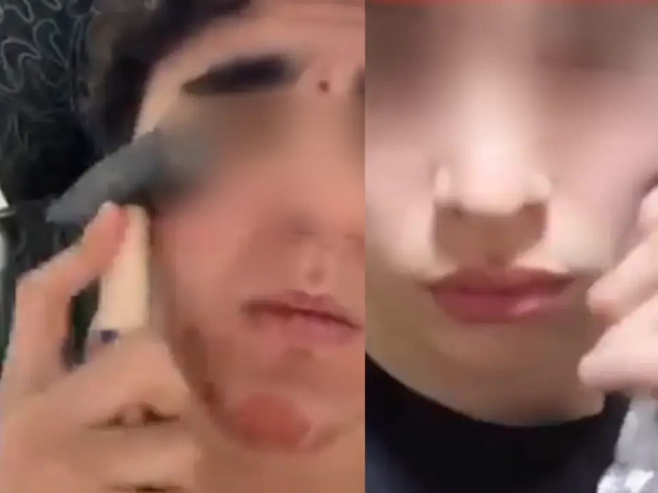 Bonesmashing returns: Russian zoomers are hitting their faces with hammers Bonesmashing returns: Russian zoomers are hitting their faces with hammers