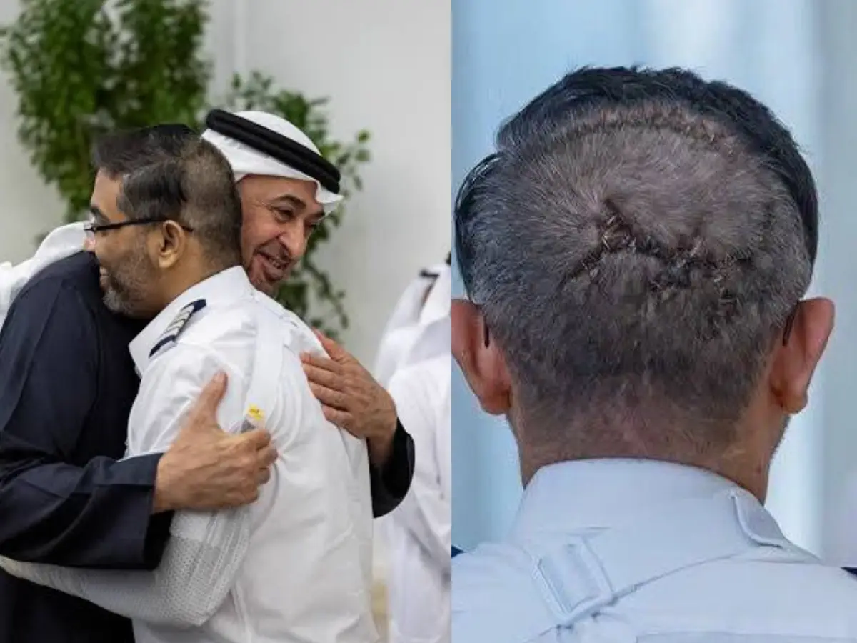 'Teach me how to fight': UAE president's special request to Indian pilot Smit Machchhar goes viral, head injuries visible for first time 'Teach me how to fight': UAE president's special request to Indian pilot Smit Machchhar goes viral, head injuries visible for first time